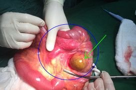 Bệnh nhân bị lồng ruột do khối u ruột non gây ra được cứu