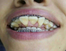 Phát hoảng với cô gái sở hữu hàm răng chĩa ngược, 'chọc' vào mắt người nhìn