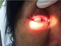 May mắn được thay giác mạc, lại bị chồng đấm vỡ nhãn cầu