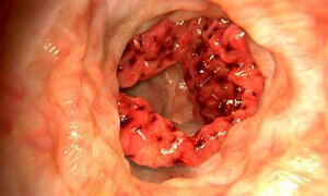 Mỗi năm có khoảng 500.000 người chết vì ung thư đại trực tràng