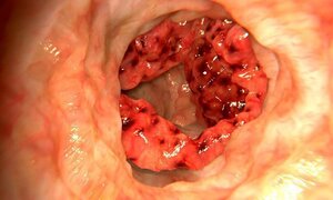 Những dấu hiệu quen thuộc cảnh báo ung thư đang tấn công cơ thể