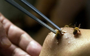 Bác sĩ bật báo động đỏ, cứu sống mẹ con sản phụ sốc phản vệ do ong đốt