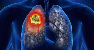 Việt Nam đứng thứ 78 các nước có tỷ lệ ung thư cao