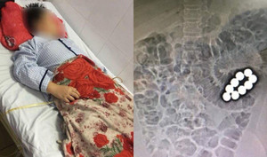 Nuốt nhiều bi nam châm vào bụng, trẻ dễ gặp tai họa chết người