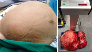 Khối u nặng 28 kg hành hạ, người phụ nữ khốn khổ nhiều năm trời