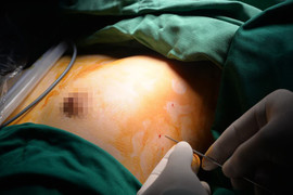 Bác sĩ Việt thực hiện thành công kỹ thuật mới, thế giới chưa ai làm được