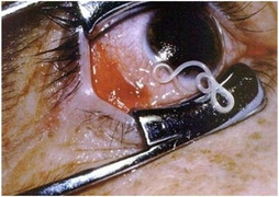 Con giun chỉ trắng ởn nghoe nguẩy, bơi lội trong mắt người đàn ông