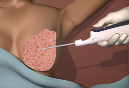 Bệnh viện đầu tiên ở TP.HCM dùng kỹ thuật hút chân không sinh thiết khối u tuyến vú