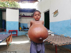 Clip: Bé trai 9 tuổi bụng phình to vì căn bệnh hiếm gặp