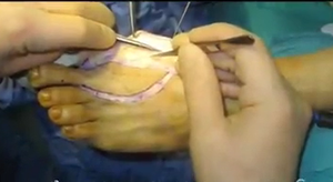 Bác sĩ phẫu thuật chuyển ngón chân thành ngón tay cho bệnh nhân