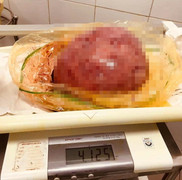 Những dấu hiệu của bệnh ung thư buồng trứng