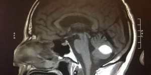 Những dấu hiệu của bệnh ung thư buồng trứng