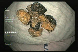 Ăn quả hồng giòn, người phụ nữ nhập viện cấp cứu