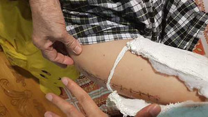 Học sinh lớp 2 bị gãy chân trong sân trường: Giáo viên tiết lộ sự thật sợ bị trù dập