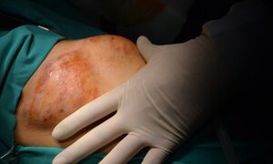 Tự chữa khối u ở ngực bằng thuốc nam, một phụ nữ nhận 'quả đắng'