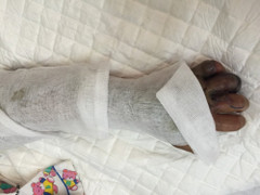 Đắp lá thuốc chữa rắn hổ đất cắn, bệnh nhi 10 tuổi hoại tử bàn tay thối thịt