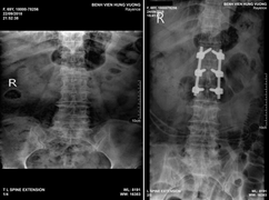 Tai nạn vỡ đốt sống lưng, người phụ nữ 65 tuổi suýt tàn phế suốt đời được cứu