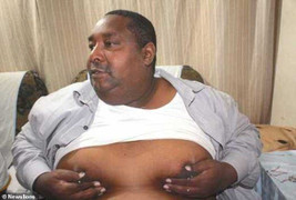 Mắc bệnh lạ, ngực người đàn ông liên tục chảy 'sữa' như gái đẻ