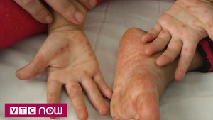 Thấy dấu hiệu này hãy đưa ngay con tới bệnh viện, nếu không muốn trẻ mất mạng