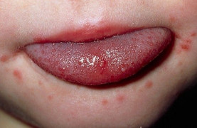 Chuyên gia chỉ cách phân biệt bệnh tay chân miệng với các bệnh khác?