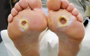 Kẻ giết người thầm lặng này dễ gây biến chứng mù lòa, suy thận, nhồi máu cơ tim