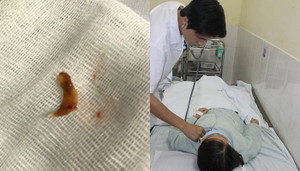 Mảnh xương vịt mắc ngang cổ họng, một phụ nữ được cứu kịp thời