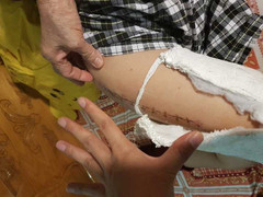 Học sinh lớp 2 bị gãy chân trong sân trường: Giáo viên tiết lộ sự thật sợ bị trù dập