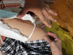 Học sinh lớp 2 bị gãy chân trong sân trường: Giáo viên tiết lộ sự thật sợ bị trù dập