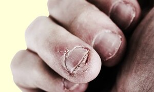 7 điều kinh khủng sẽ xảy ra nếu bạn cắn móng tay