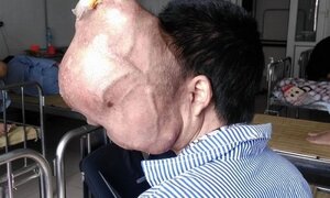 Kinh hãi khối u khổng lồ ăn dần não của người đàn ông