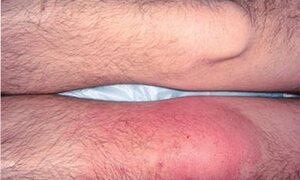 Quan hệ không mang 'áo mưa': Nam thanh niên mắc bệnh hiếm