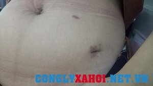 Hòa Bình: Bị u nang buồng trứng bên trái, bác sỹ mổ... bên phải