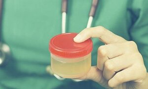 Nước tiểu sậm màu có thể là dấu hiệu của... ung thư?