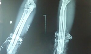 Nối thành công bàn tay bị đứt lìa do ẩu đả ở Khánh Hòa