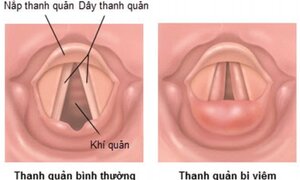 Suýt chết do ngạt thở vì hóc xương cá mà không đi khám