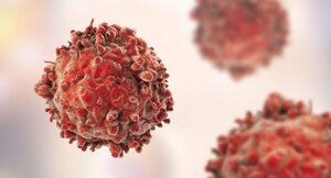 Những dấu hiệu sớm cảnh báo bệnh ung thư máu