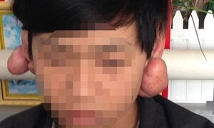 Kinh hoàng nổi u, phù tai sau khi bấm lỗ tai