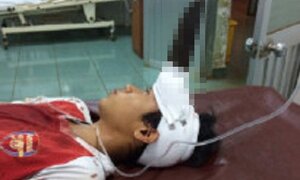 Bị dao găm vào trán, bé trai 12 tuổi chấn thương sọ não