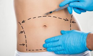 Thẩm mỹ cắt da thừa và những rủi ro đáng sợ
