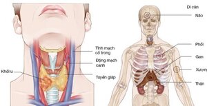 Khàn tiếng suốt 6 tháng, đi khám phát hiện khối u ung thư cứng như đá