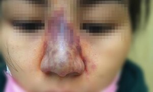 Cô gái suýt hoại tử mũi sau khi tiêm chất làm đầy giá rẻ