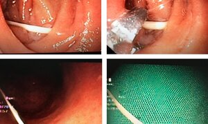 Hy hữu: Cụ bà suýt thủng ruột vì cây tăm tre rơi trong bụng