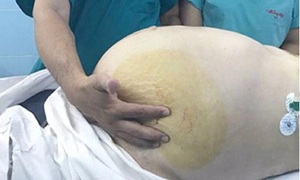 Cụ bà 74 tuổi được phẫu thuật loại bỏ khối u nặng 20kg trong ổ bụng