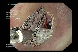 Uống thuốc nuốt luôn cả vỏ, một phụ nữ suýt mất mạng