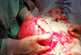 Cụ bà 57 tuổi có khối u xơ to như mang thai ở Nghệ An