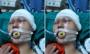 Nam sinh bị nhóm người đánh chấn thương sọ não ở Hà Nội