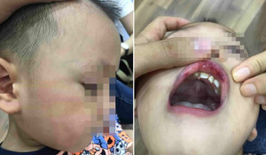 Cô giáo mầm non ở Hà Nội tát trẻ bầm dập, tụ máu môi