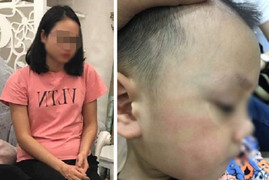 Đánh trẻ 3 tuổi ở Hà Nội bầm dập, tụ máu môi, cô giáo hoảng loạn, tìm cách tự tử