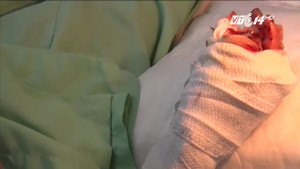 Vì sao ngày càng nhiều lao động trẻ bị tai nạn đứt lìa bàn tay?