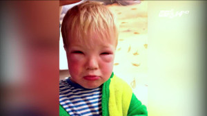 Mẹ nhuộm tóc làm đẹp, con trai 2 tuổi mù tạm thời